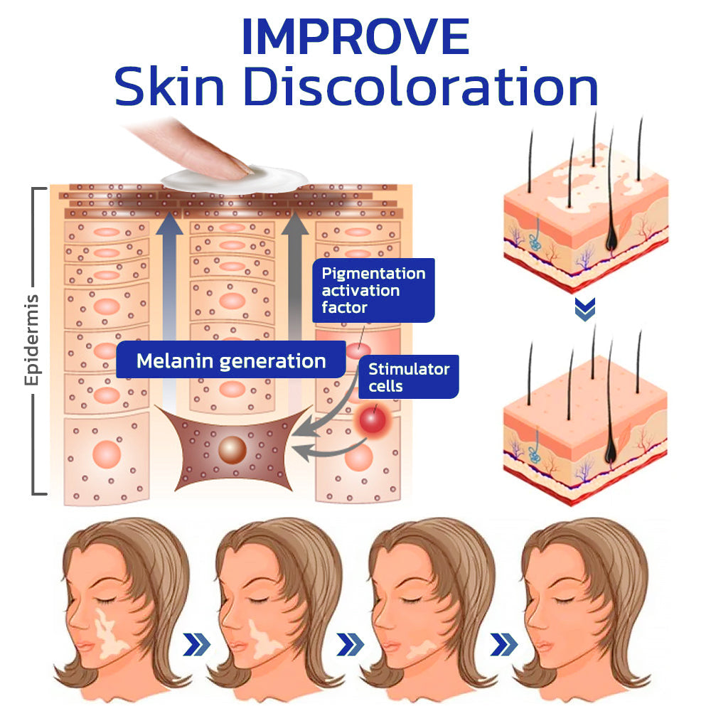 ODEIUN™ Vitiligo Cream - Elimination of deep white blood cells