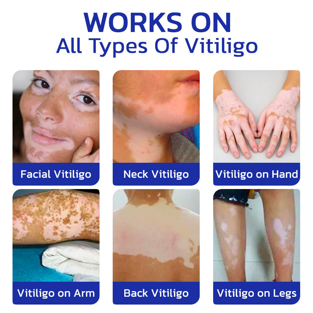 ODEIUN™ Vitiligo Cream - Elimination of deep white blood cells
