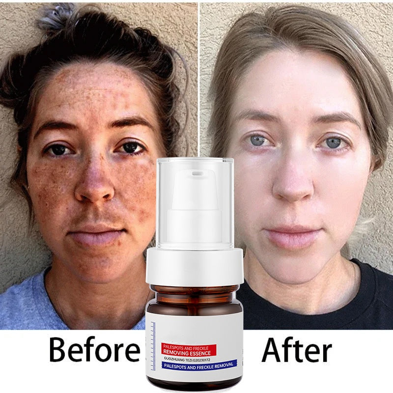 ⚡5-second brightening rescue: Dark spots disappear, blemishes fade, and skin becomes radiant! Vitamin C Whitening Freckles ESSENCE