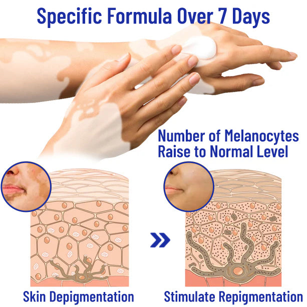 ODEIUN™ Vitiligo Cream - Elimination of deep white blood cells