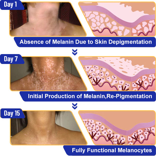 ODEIUN™ Vitiligo Cream - Elimination of deep white blood cells