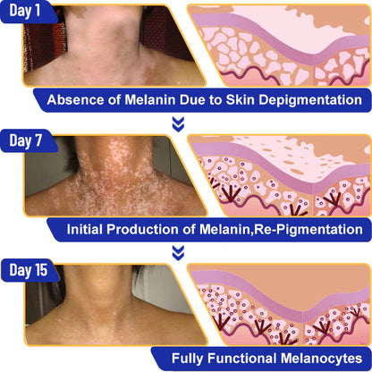 ODEIUN™ Vitiligo Cream - Elimination of deep white blood cells