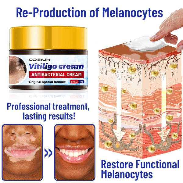 ODEIUN™ Vitiligo Cream - Elimination of deep white blood cells