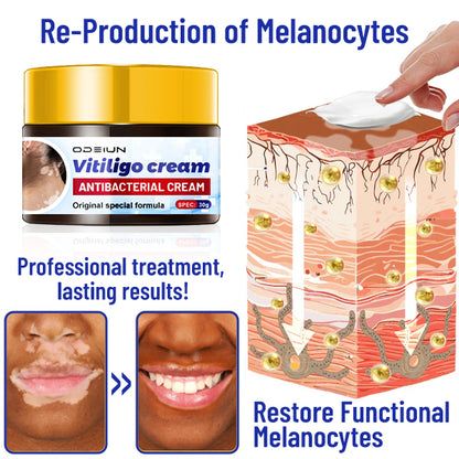 ODEIUN™ Vitiligo Cream - Elimination of deep white blood cells