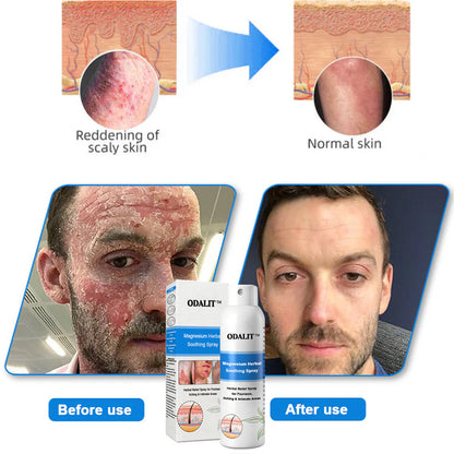 ✅Official Store: ODALIT®Magnesium Herbal Psoriasis Spray⚕️MHRA certified (Eliminates psoriasis and eczema, treats bacterial infections in the genital area, relieves joint pain and neuropathic pain, and treats acne and pigmentation)