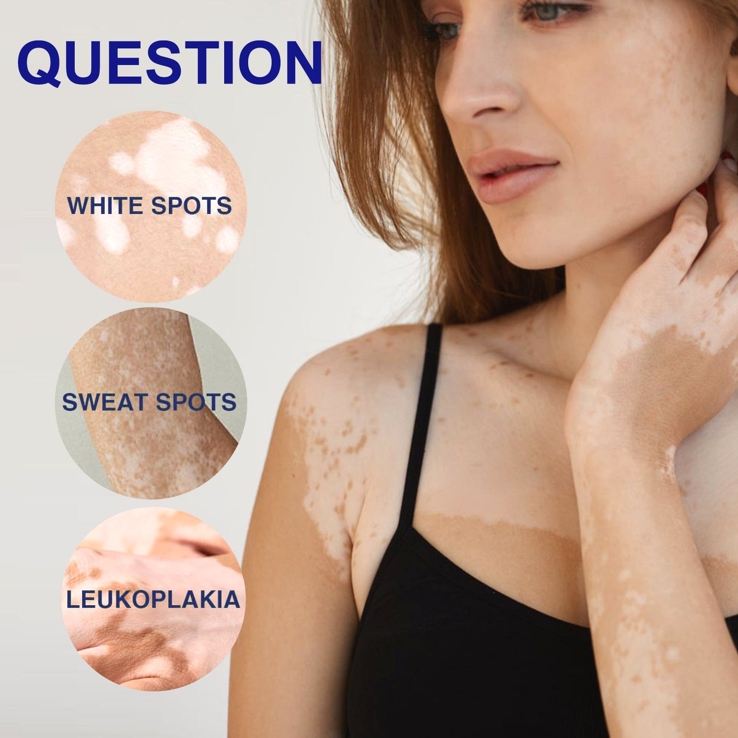 ODEIUN™ Vitiligo Cream - Elimination of deep white blood cells