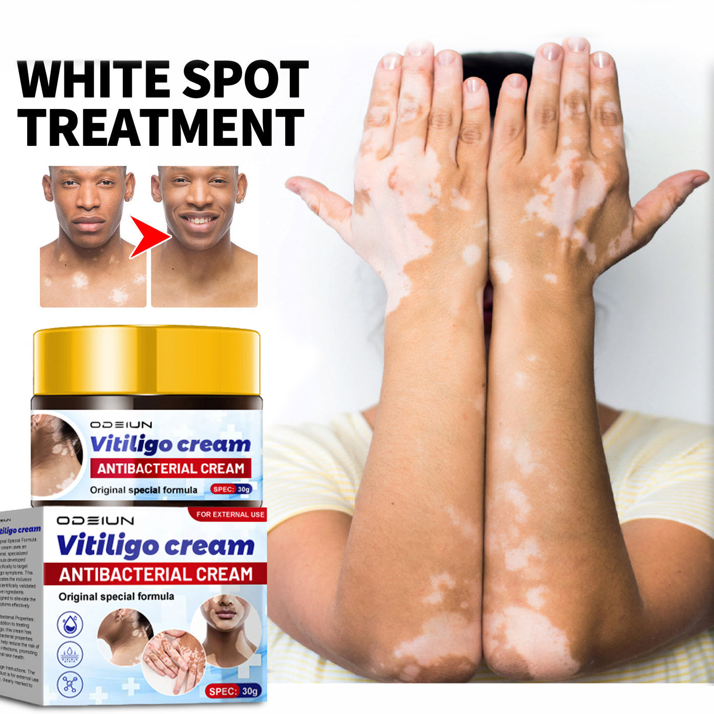 ODEIUN™ Vitiligo Cream - Elimination of deep white blood cells
