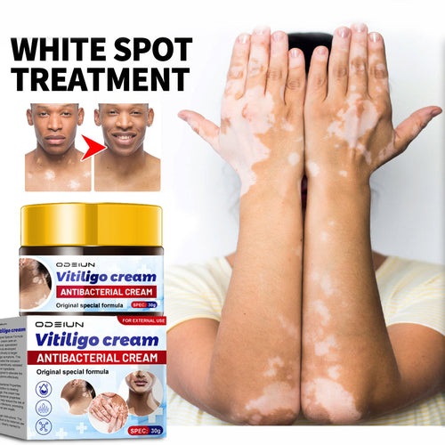 ODEIUN™ Vitiligo Cream - Elimination of deep white blood cells