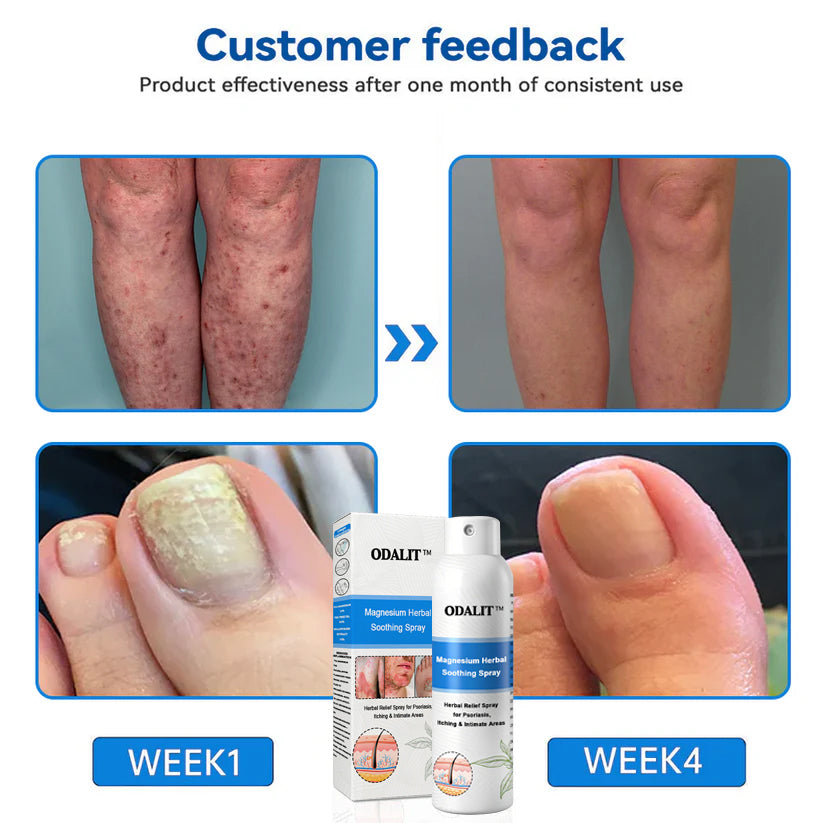✅Official Store: ODALIT®Magnesium Herbal Psoriasis Spray⚕️MHRA certified (Eliminates psoriasis and eczema, treats bacterial infections in the genital area, relieves joint pain and neuropathic pain, and treats acne and pigmentation)