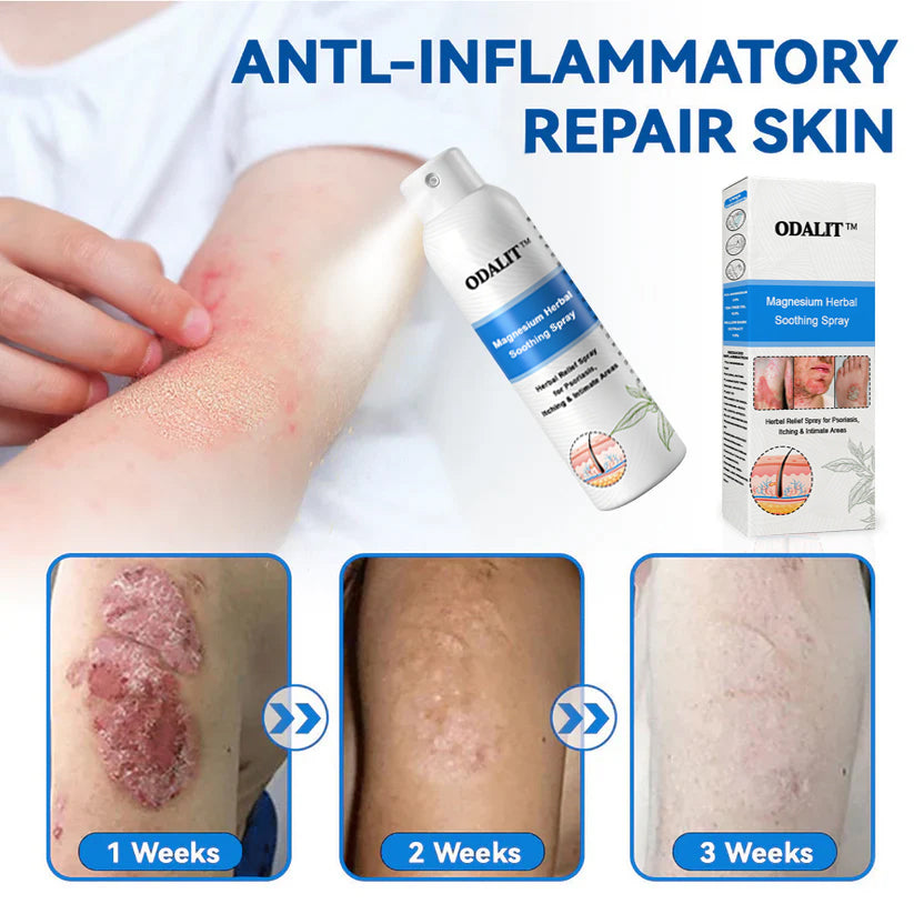 ✅Official Store: ODALIT®Magnesium Herbal Psoriasis Spray⚕️MHRA certified (Eliminates psoriasis and eczema, treats bacterial infections in the genital area, relieves joint pain and neuropathic pain, and treats acne and pigmentation)