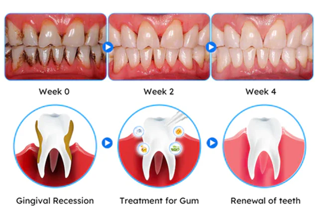ODEIUN™ Gum Therapy Gel - Upgraded formula