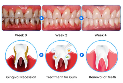 ODEIUN™ Gum Therapy Gel - Upgraded formula