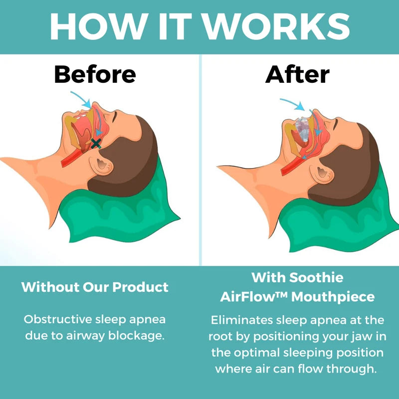 Seurico™ Mouthpiece